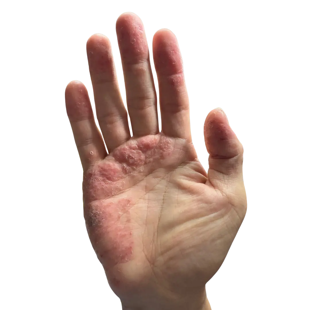 Eczema starts in your gut.