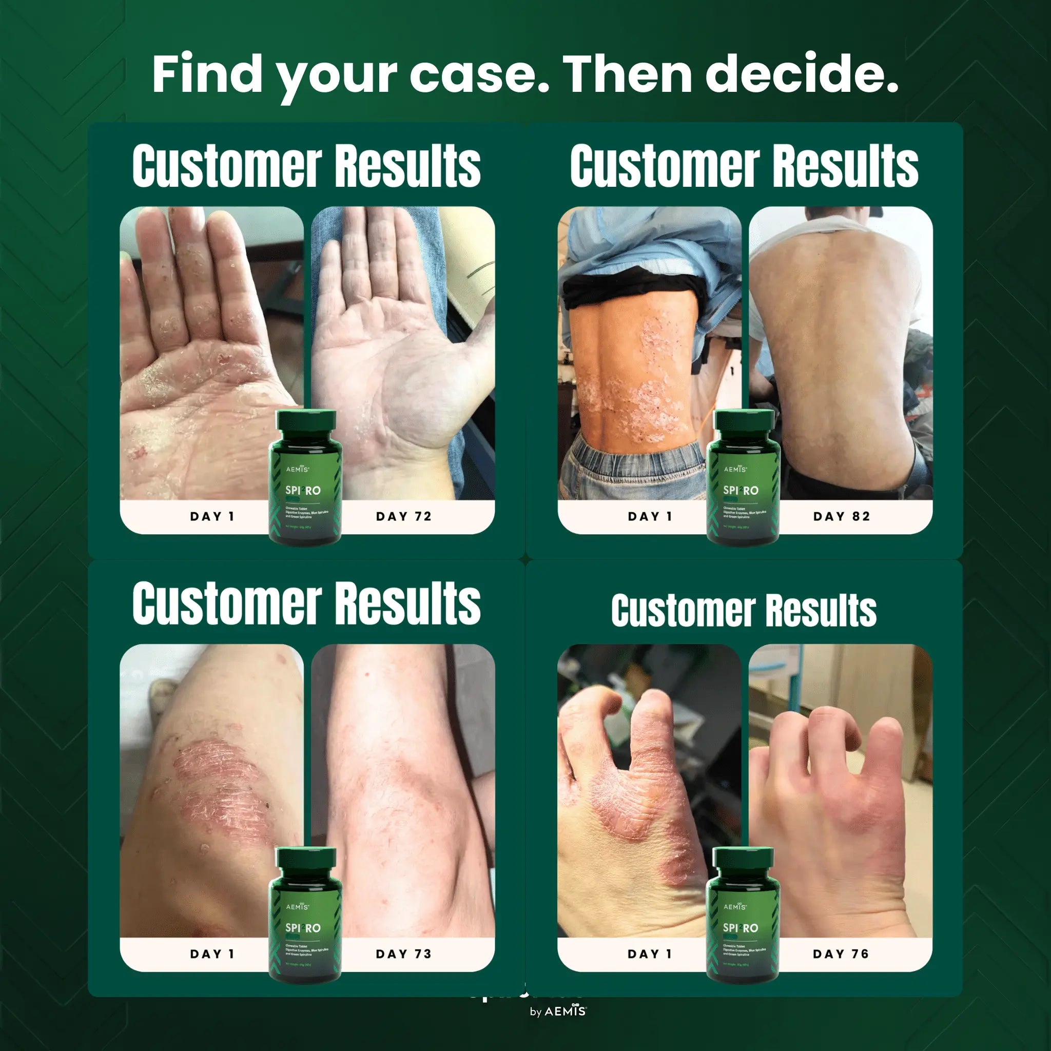 SpiroPlus (Eczema Solution Backed by Gut Science)